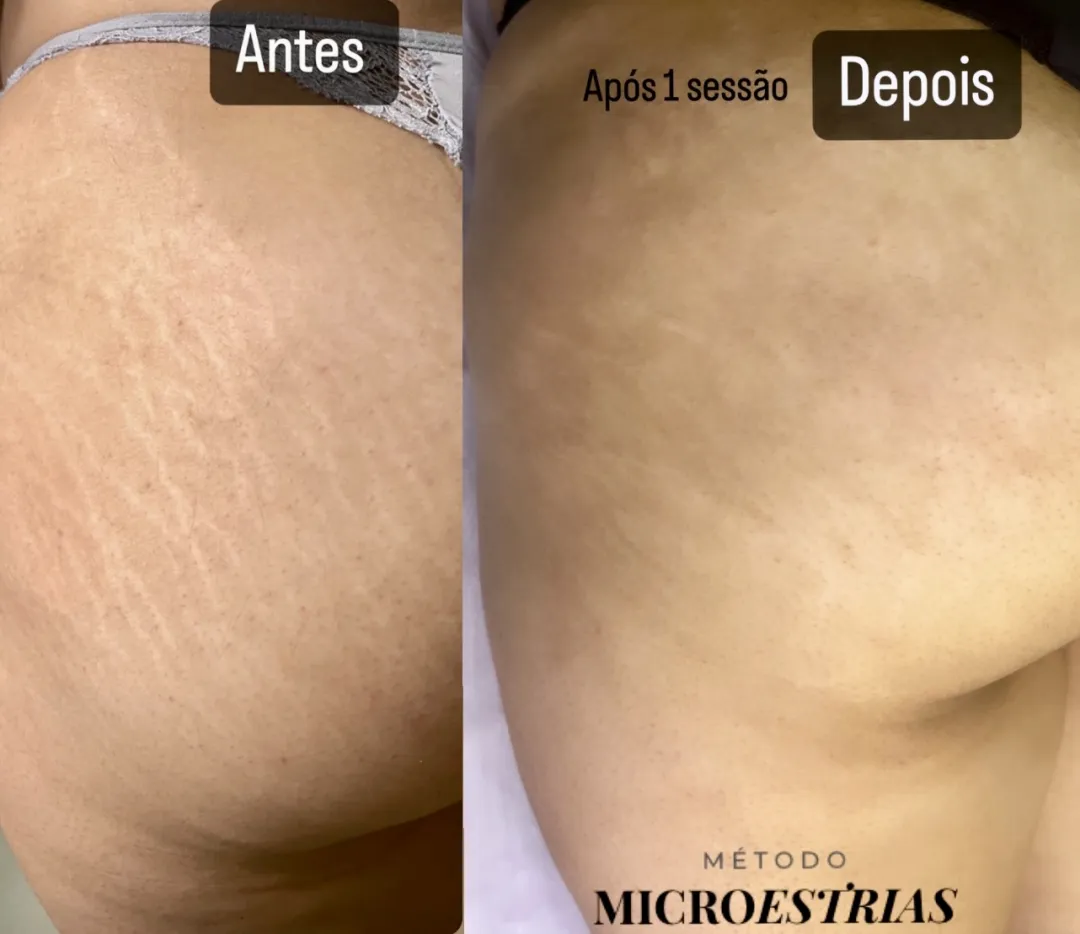 Antes e depois de estrias nos glúteos e coxas — resultado após 1 sessão do Método MicroEstrias