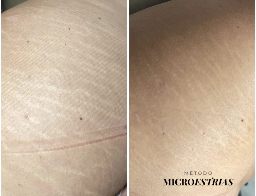 Antes e depois de estrias no quadril tratadas com o Método MicroEstrias