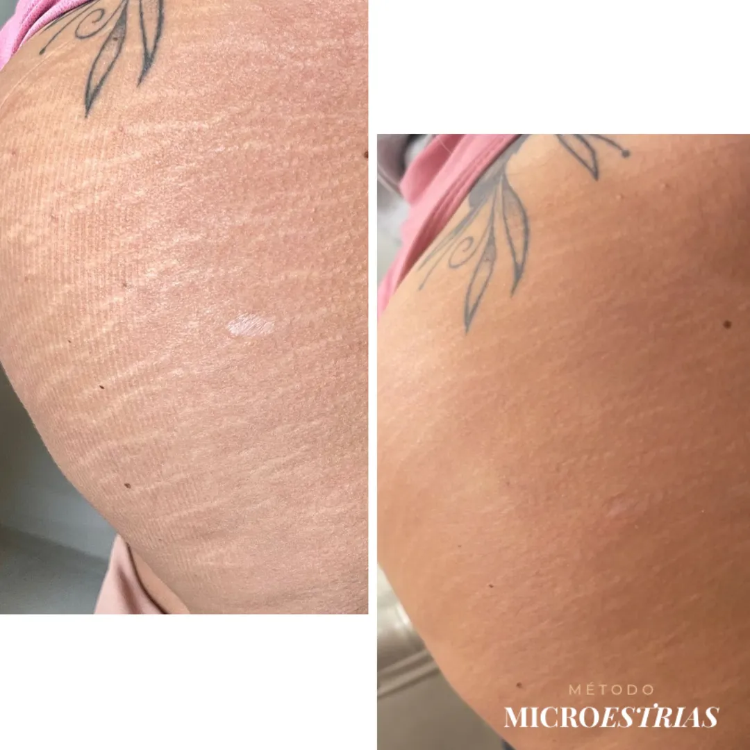 Antes e depois de estrias brancas no quadril tratadas com o Método MicroEstrias