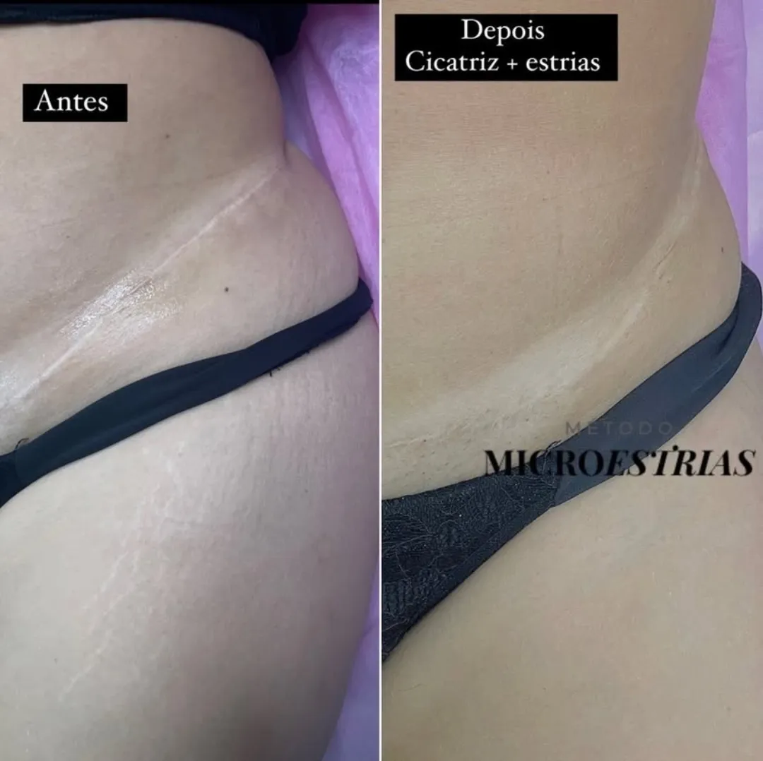 Antes e depois de cicatriz e estrias no abdômen tratadas com o Método MicroEstrias