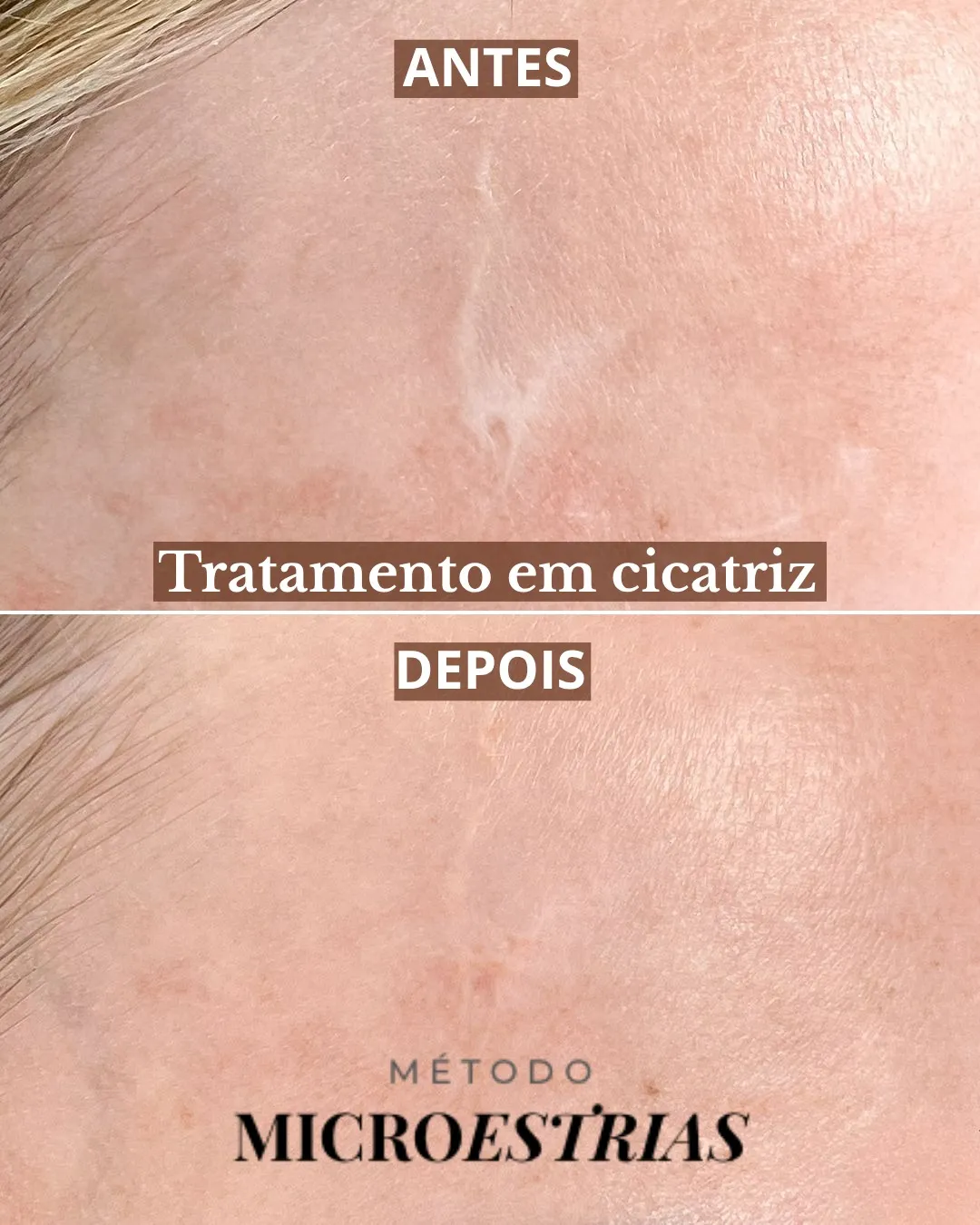 Antes e depois de cicatriz na testa tratada com o Método MicroEstrias