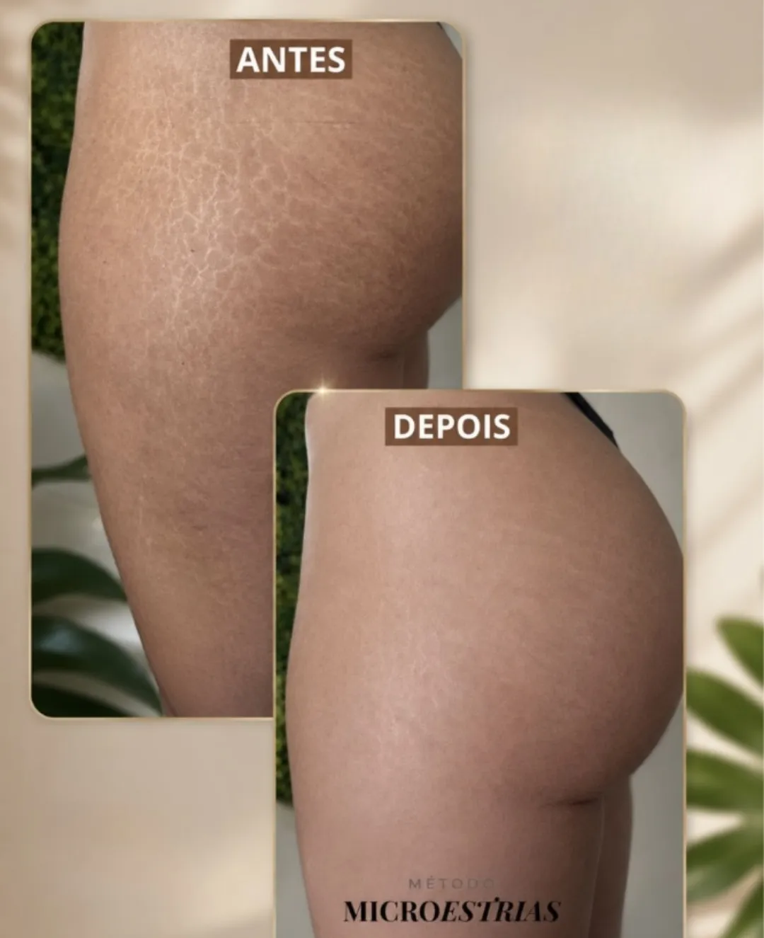 Antes e depois de estrias em coxas e glúteos tratadas com o Método MicroEstrias