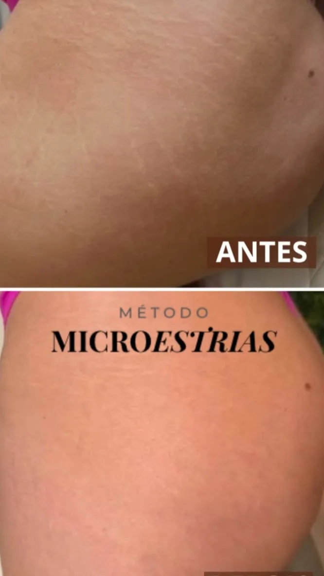Antes e depois de estrias brancas na cintura e quadril tratadas com o Método MicroEstrias